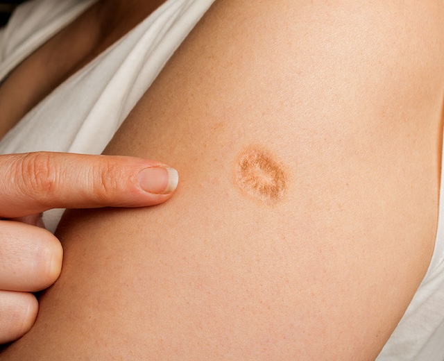 The iconic round scar, a lasting mark of a worldwide effort against smallpox