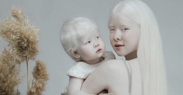 Two sisters with albinism sharing a tender moment, highlighting their close bond and the rare genetic trait they both share