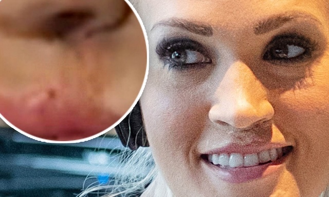 A close-up shot reveals the scars from Carrie Underwood's unfortunate accident, highlighting her journey to healing and resilience