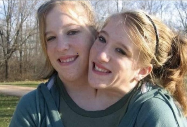 Conjoined twins Abby and Brittany enjoying a joyful moment together in a candid photo