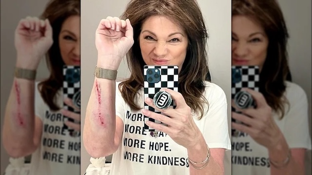 Valerie Bertinelli's recent Instagram post where she shared an injury on her arm, sparking concern among fans