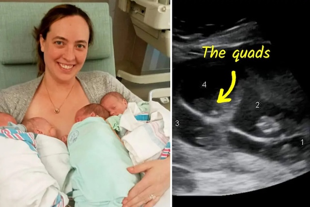 A mother holding her quadruplets just after birth, alongside an ultrasound image showing all four babies