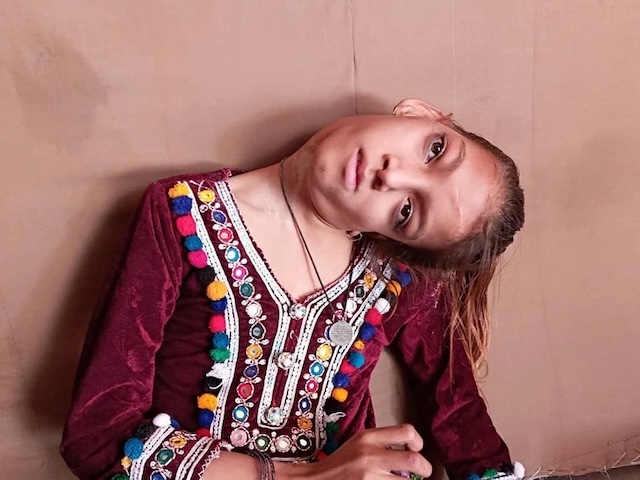 Although born a healthy child, an accident completely changed Afsheen's life