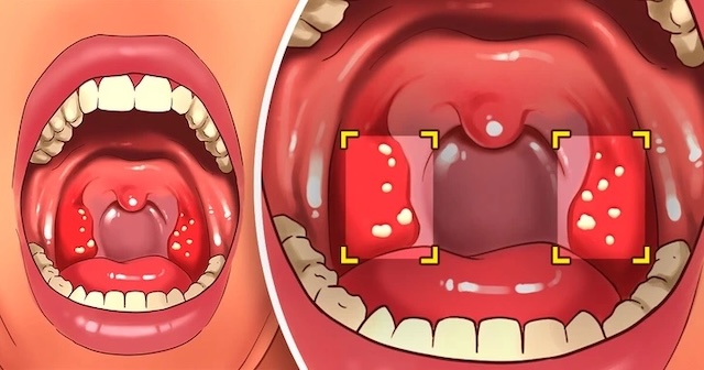 A close-up of tonsils with stones showcases another surprising symptom of gluten sensitivity that might improve with dietary changes