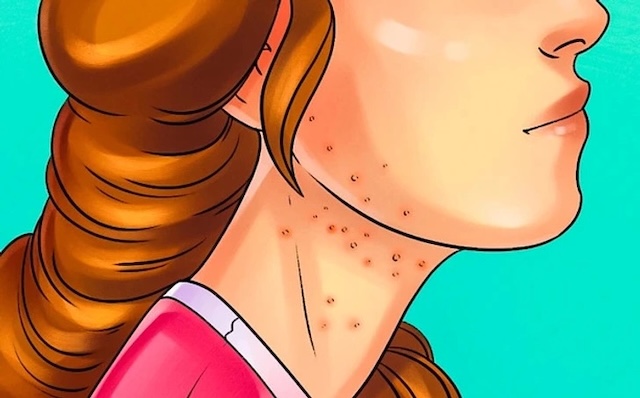 Close-up of skin with bumps and rashes emphasizes dermatological conditions caused by gluten sensitivity