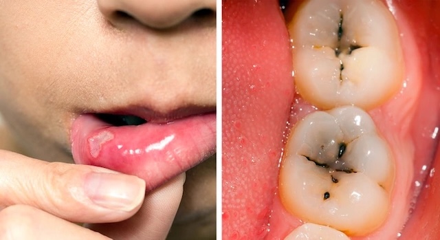 Image of decayed teeth and mouth sores reflects dental problems due to nutrient absorption issues linked to gluten sensitivity