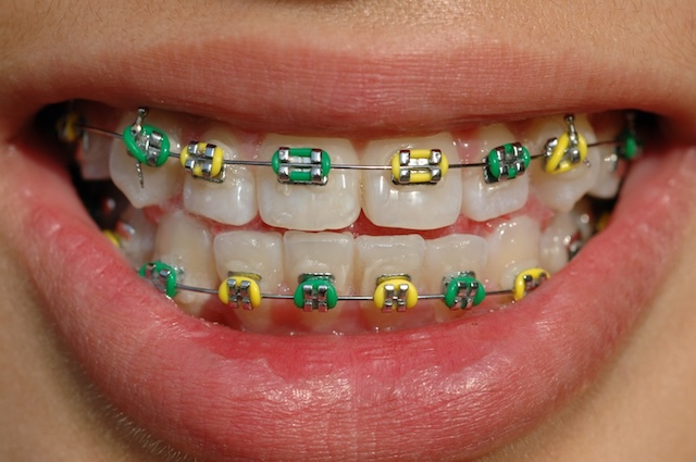 A vibrant display of colorful braces on teeth, highlighting the use of orthodontic bands to correct dental alignment