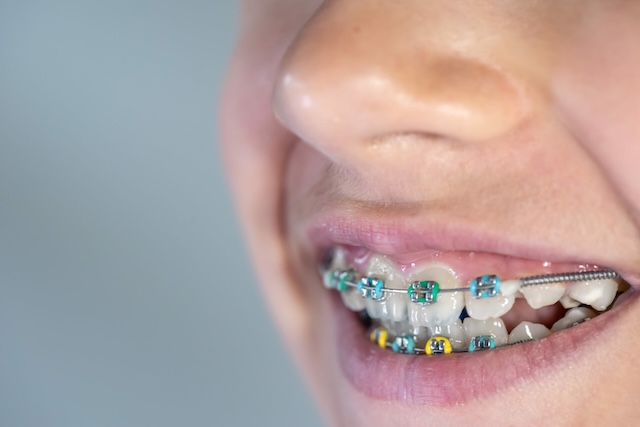 A cheerful side profile of a patient wearing braces, emphasizing the intricate role of rubber bands in orthodontic adjustments