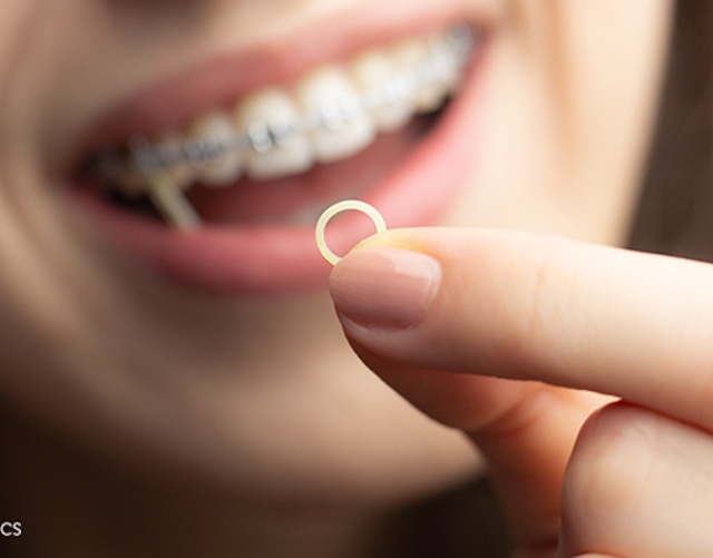 A patient demonstrating a small orthodontic rubber band, showcasing how these tiny tools play a significant role in achieving the perfect smile