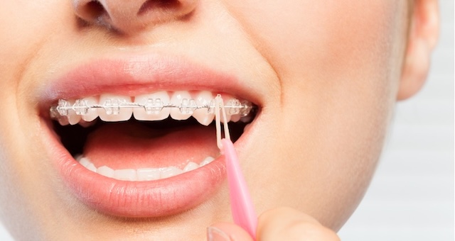 An orthodontic tool being used to apply a rubber band onto braces, illustrating the precision and care required in orthodontic treatments