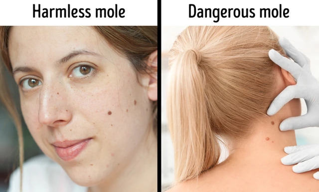 Removing Moles is Dangerous