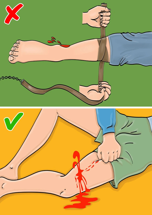 Severe Bleeding: Avoid Immediate Tourniquet Use