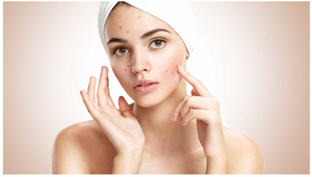 What Your Acne Says About Your Lifestyle: A Complete Guide to Clear Skin