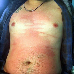 Boyfriend Fell Asleep at the Beach and Paid the Price