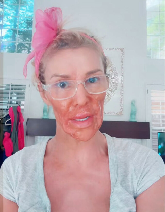 Brandi documents her battle publicly, here seen with a healing mask as she continued searching for answers.