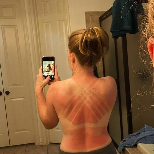 Expired Sunscreen Catastrophe at a Waterpark