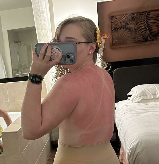 Hawaii Vacation Sunburn with “Hell’s Itch”