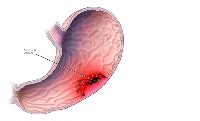 Medical illustration showing a stomach cancer lesion—silent but dangerous if left unchecked.