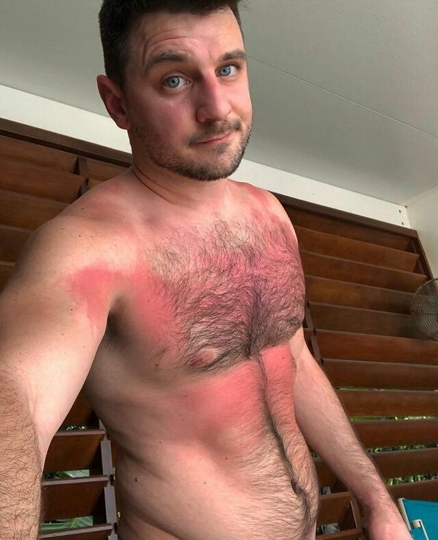 Missed Hairline Sunscreen, Painful Surprise