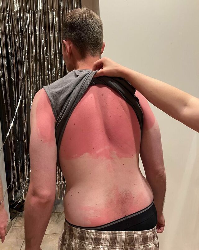 Missed Sunscreen on the Back—No One to Help