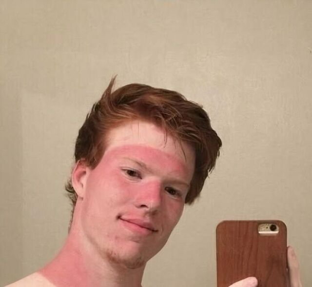 Red Hair Perks: Free Cancer from the Sun
