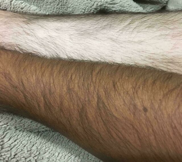 Shocking Difference Between Tanned and Untanned Skin