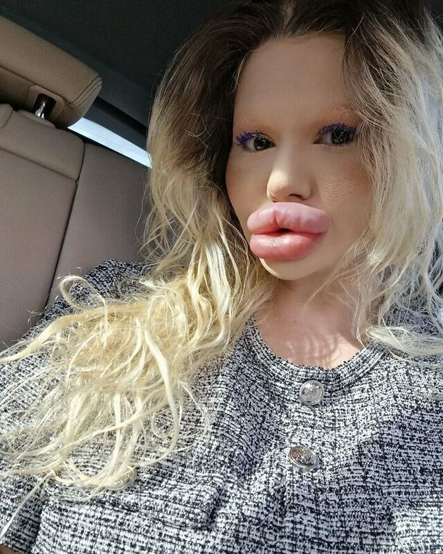 Since 2018, Andrea has spent over £20,000 (around $26,700) on lip fillers alone, alongside a series of facial enhancements that have radically altered her appearance