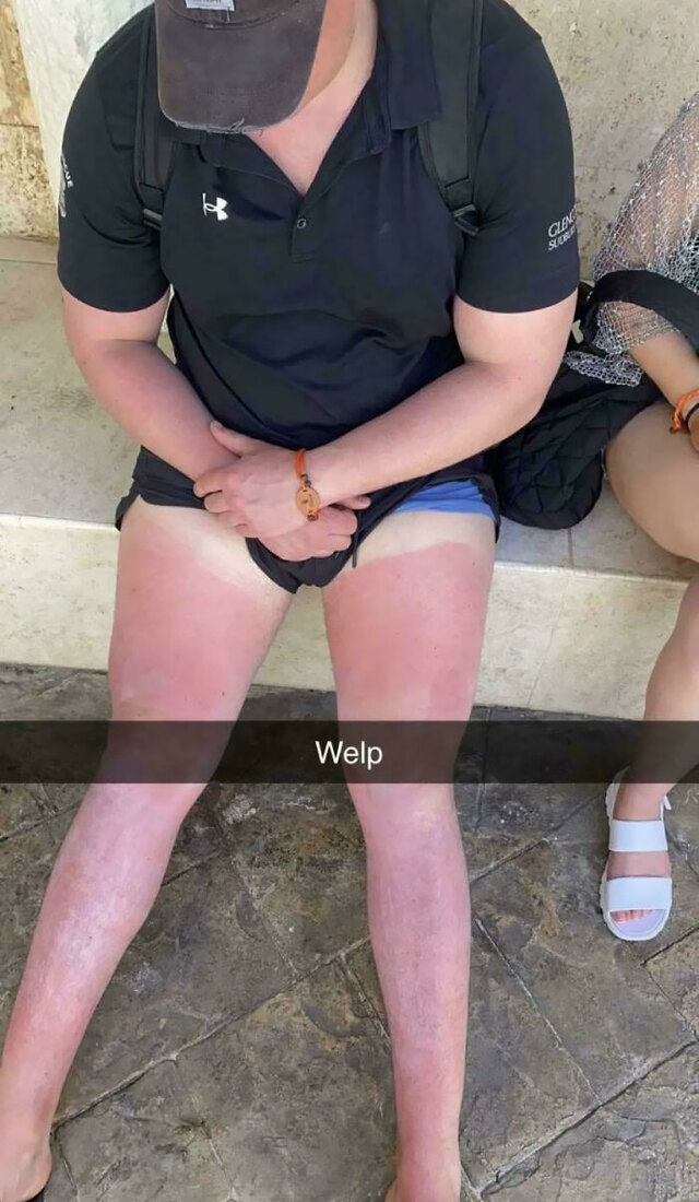 Sunburned Vacation in Mallorca: The Brit Classic