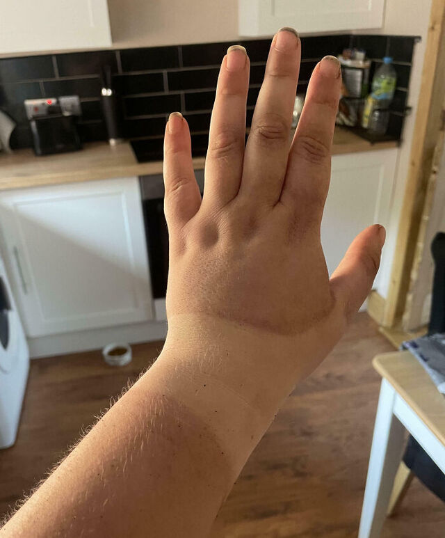 Thumb Splint Tan Line After Days Outdoors