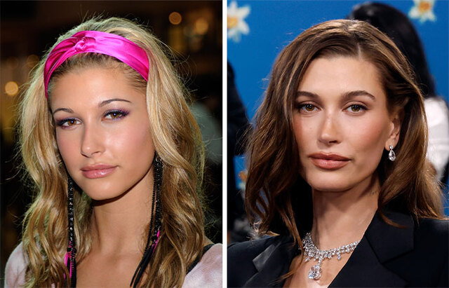 Hailey Bieber: The Subtle Shift in Her Cheeks