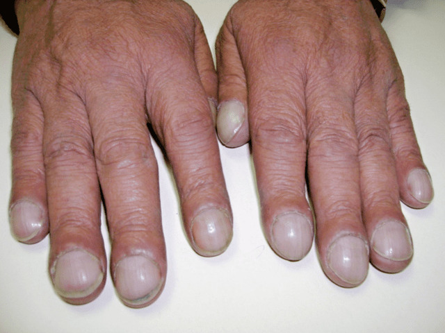 Curved or Clubbed Fingernails: The Shape That Speaks Volumes