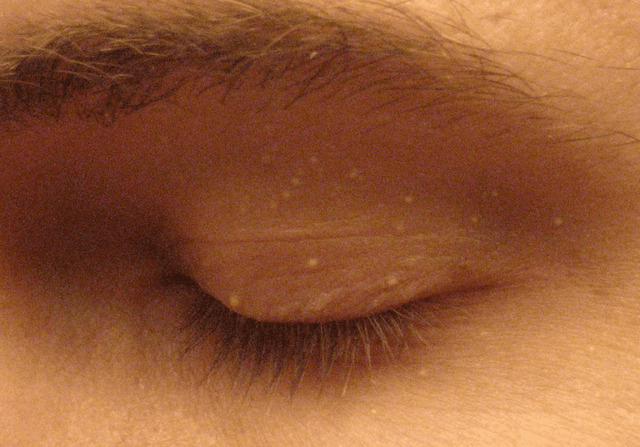 Small White Bumps Near Eyelids: Tiny but Telling