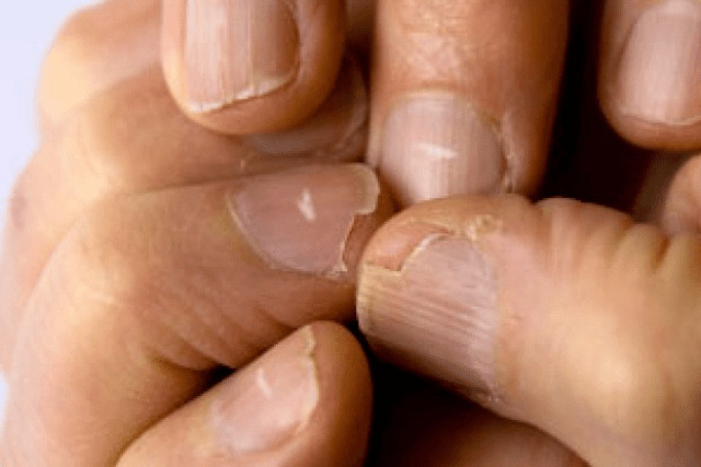 White Spots on Nails: Small Marks with Big Meaning
