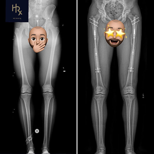Limb-lengthening surgery is one of the most complex reconstructive procedures in modern medicine