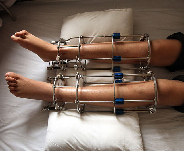 She also experienced two serious bone infections, complications that required further treatment and significantly slowed her recovery