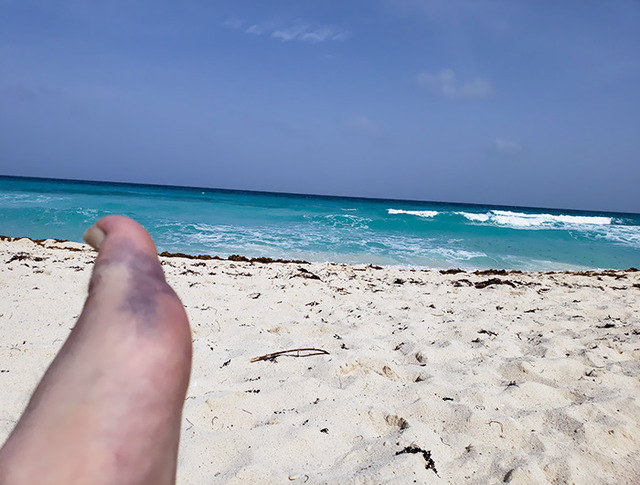 Breaking a foot in Cancun on the first day of the honeymoon.