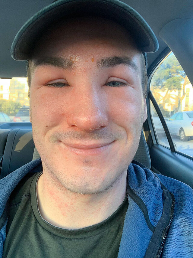 Hiking to blow off steam, but an allergic reaction ruins the day.