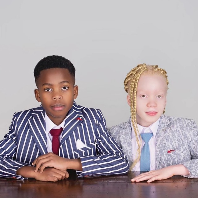 The twins captured the hearts of people around the world, sparking conversations about beauty, family, and the importance of acceptance.