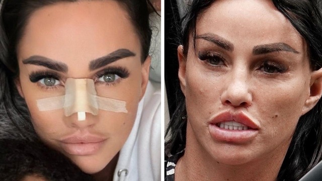 A raw glimpse into the recovery process and the painful reality of chasing aesthetic perfection.