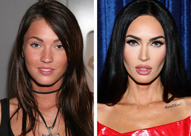 Megan Fox stays transparent about her procedures, arguing that no one should be shamed for wanting to improve.